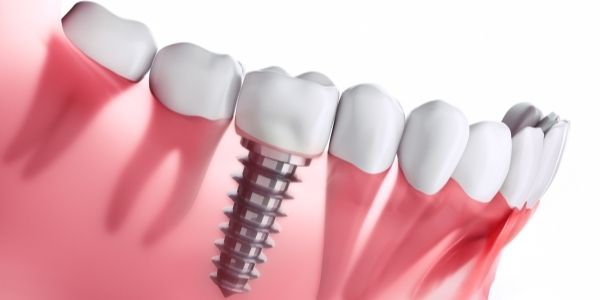 Dental implant surgery