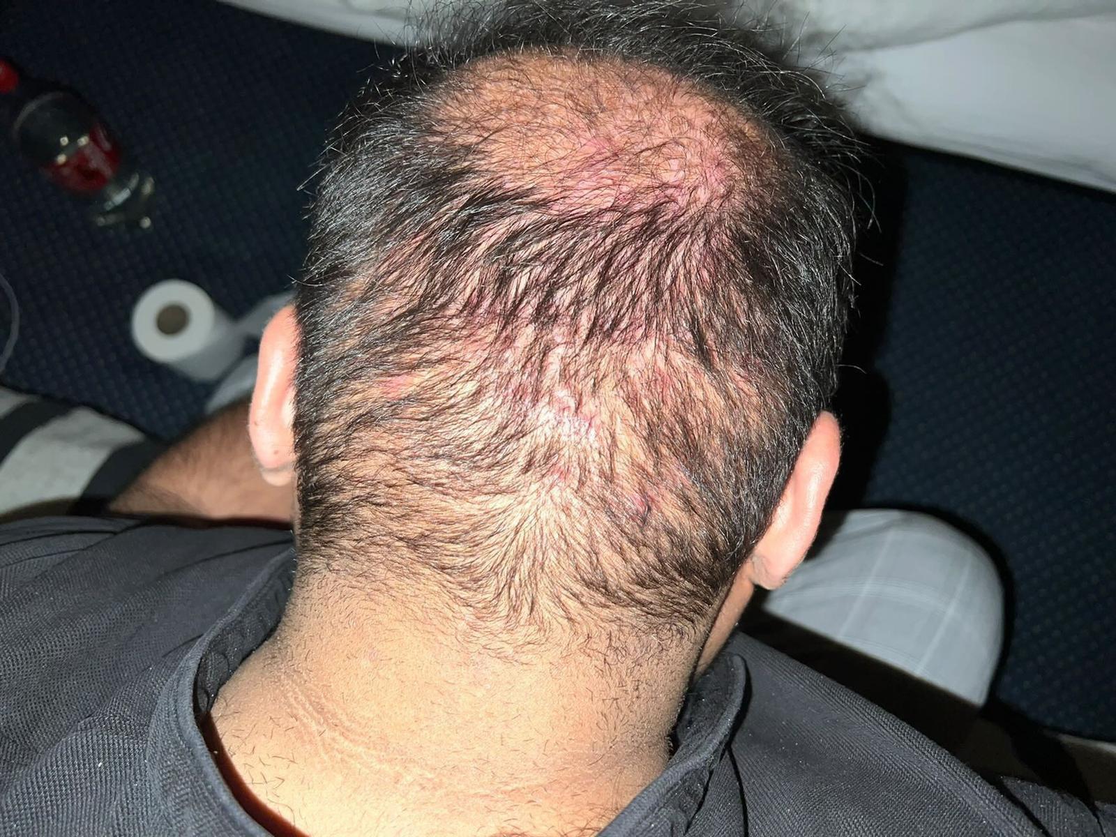 A Man's Head With Less Hairs